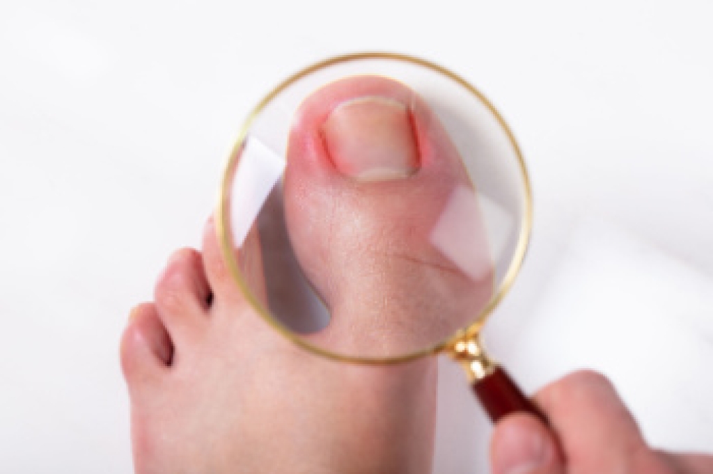 Ingrown Toenails and Why Podiatric Care Matters