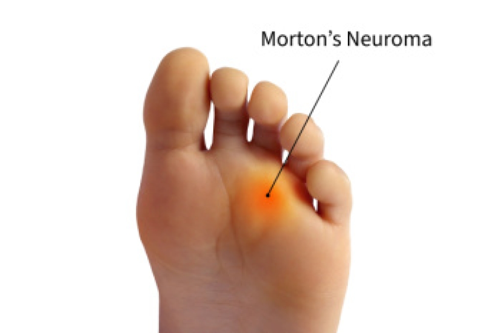 How a Podiatrist Diagnoses and Treats Morton’s Neuroma