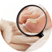 Toenail Fungus Diagnosis and Treatment