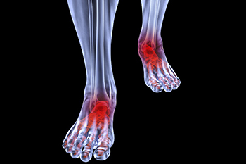 Arthritic foot care in the San Diego County, CA: Oceanside (Carlsbad, Vista, San Marcos, Escondido, Encinitas, Solana Beach, Valley Center, Poway, Camp Pendleton North, Fall Brook) areas
