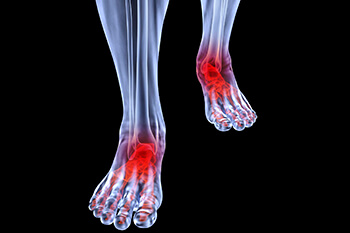 Arthritic foot care in the San Diego County, CA: Oceanside (Carlsbad, Vista, San Marcos, Escondido, Encinitas, Solana Beach, Valley Center, Poway, Camp Pendleton North, Fall Brook) areas