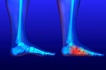 Flat feet treatment in the San Diego County, CA: Oceanside (Carlsbad, Vista, San Marcos, Escondido, Encinitas, Solana Beach, Valley Center, Poway, Camp Pendleton North, Fall Brook) areas