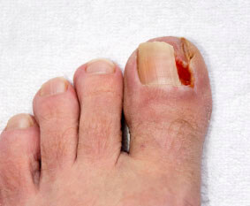 ingrown toenail treatment in the San Diego County, CA: Oceanside (Carlsbad, Vista, San Marcos, Escondido, Encinitas, Solana Beach, Valley Center, Poway, Camp Pendleton North, Fall Brook) areas