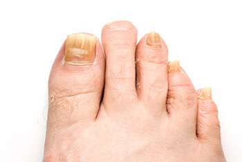 Toenail fungus treatment in the San Diego County, CA: Oceanside (Carlsbad, Vista, San Marcos, Escondido, Encinitas, Solana Beach, Valley Center, Poway, Camp Pendleton North, Fall Brook) areas