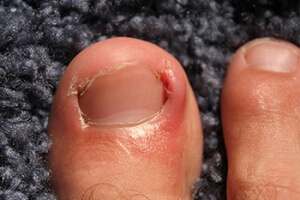 Ingrown Toenails and Runners