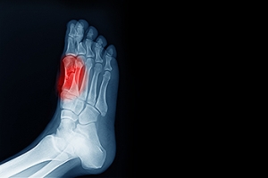 Sesamoid Fracture Treatment