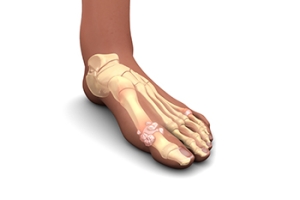 Gout and Its Impact on the Feet