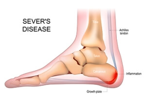 Exploring Sever&#039;s Disease