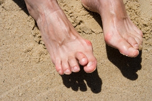 Do I Have Hammertoe?