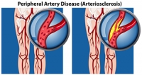 Am I at Risk for Peripheral Artery Disease?