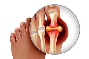 Pediatric Gout