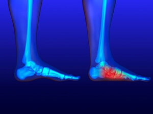 What Is Foot Overpronation?