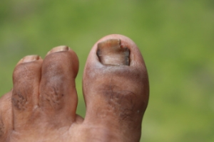 Facts About Detached Toenails