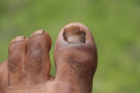Facts About Detached Toenails