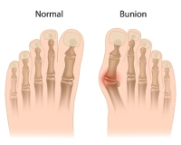 Overpronation and Hypermobility May Cause Bunions