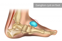 Ganglion Cysts on the Feet