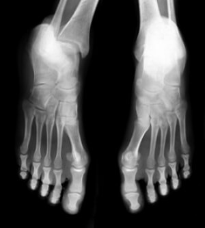 Effects of Having a Stress Fracture