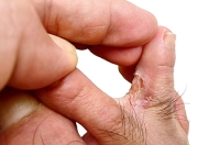 Flaky Skin Between the Toes
