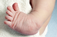 Foot Deformities in Newborns