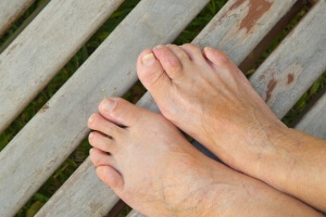 Hammer, Mallet, and Claw Toes