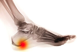 What Causes Plantar Fasciitis?