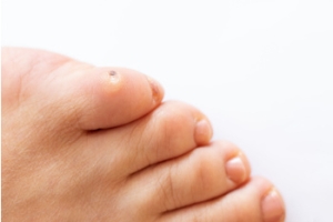 Three Types of Corns on the Feet