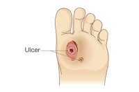 How Diabetic Foot Infections Are Diagnosed