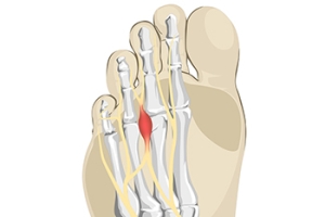 Morton’s Neuroma Symptoms and Treatment