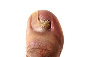 Medication May Be Necessary to Rid Toenail Fungus