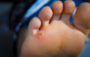 Causes and Treatment of Corns on the Feet