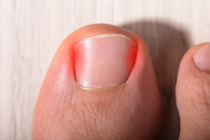 When That Toenail Starts to Hurt