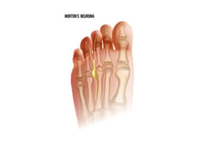 Causes and Nature of Morton&#039;s Neuroma