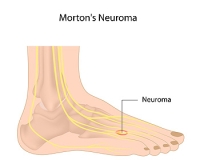 Signs and Causes of a Morton’s Neuroma